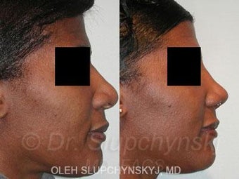 African American Rhinoplasty