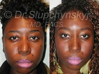 African American Rhinoplasty
