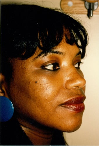 Rhinoplasty