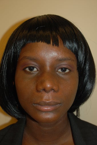 Rhinoplasty
