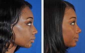 African American Ethnic Rhinoplasty
