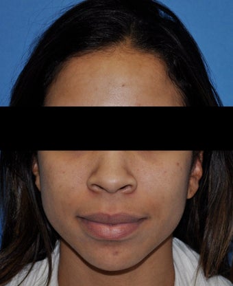African American Rhinoplasty