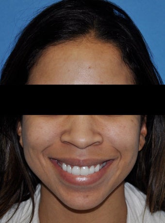 African American Rhinoplasty