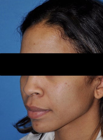 African American Rhinoplasty