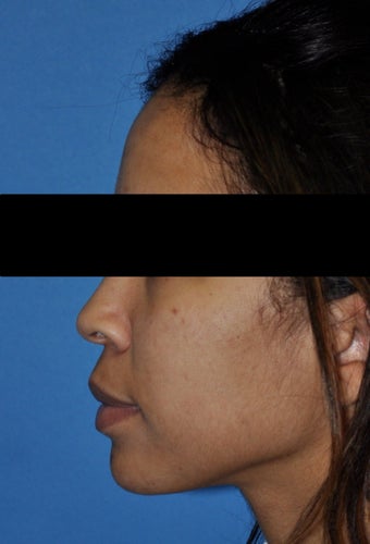 African American Rhinoplasty