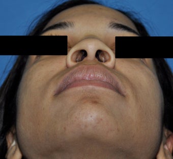 African American Rhinoplasty