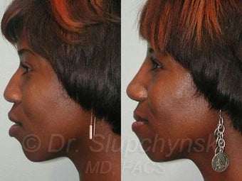 African American Rhinoplasty