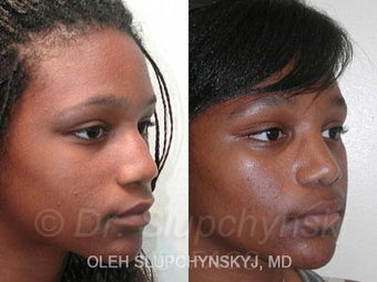 African American Rhinoplasty