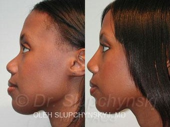 African American Rhinoplasty