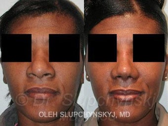 African American Rhinoplasty