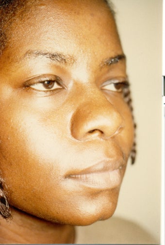 Rhinoplasty
