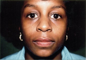 Rhinoplasty