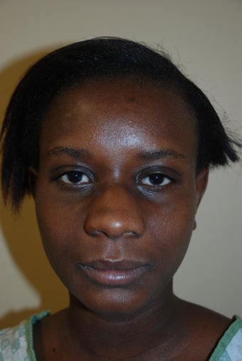 Rhinoplasty
