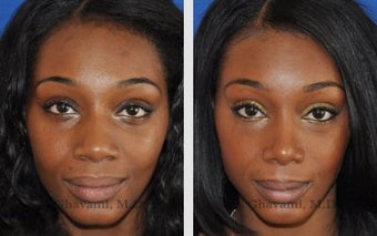 African American Ethnic Rhinoplasty