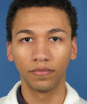 African American Rhinoplasty