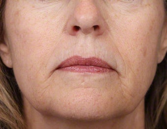 Alex Laser for Brown Spots on Face