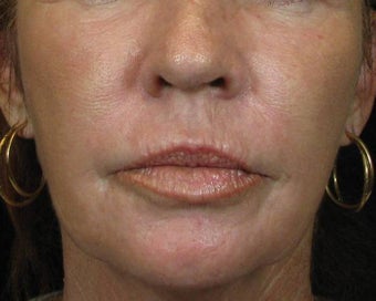 C02 Results on Aging Female Face