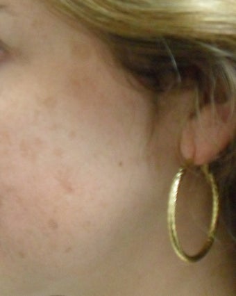 Before and After Photos From Jason R. Lupton, M.D.