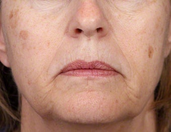 Alex Laser for Brown Spots on Face