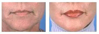 Lip augmentation with Alloderm implants