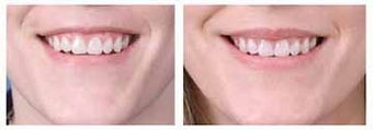 Alloderm facial implants for lip augmentation
