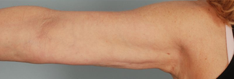 Brachioplasty