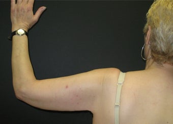 Arm Lift