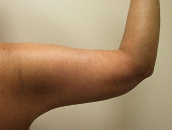 Brachioplasty