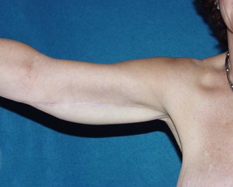 Brachioplasty