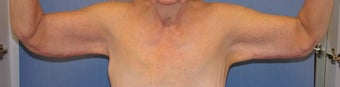 Brachioplasty
