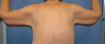 Brachioplasty
