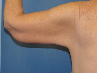 Brachioplasty