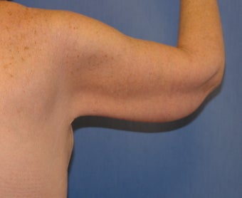 Brachioplasty