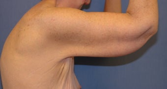 Brachioplasty