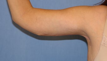 Brachioplasty