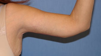 Brachioplasty