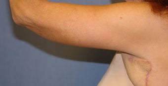 Brachioplasty