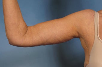 Arm Lift 