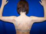Arm Lift Surgery
