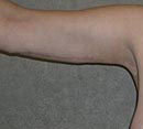 Arm Lift (Brachioplasty)