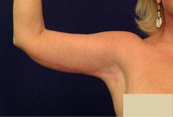 Arm Lift