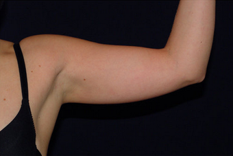 Arm Lift