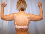 Arm Lift Surgery (Brachioplasty)