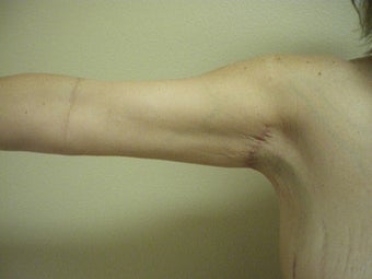 Arm Lift 