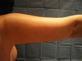 Arm Lift