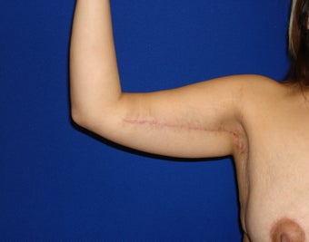 Arm lift