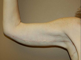 arm tuck