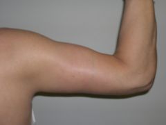 Arm Lift