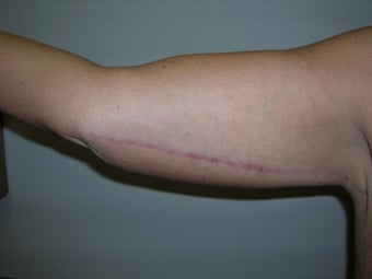Arm Lift