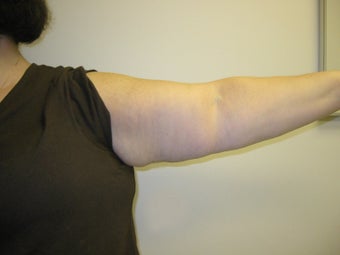 Brachioplasty